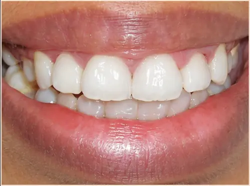 After treatment
