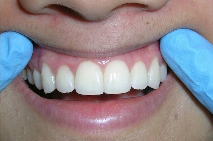 After treatment