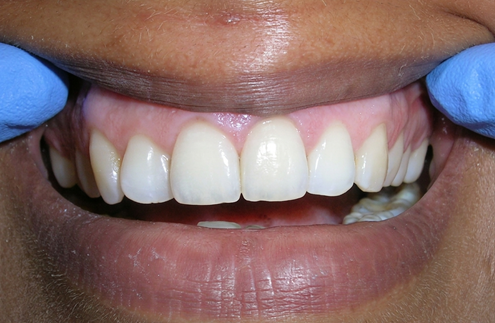 After treatment