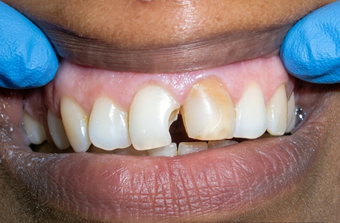 Before treatment