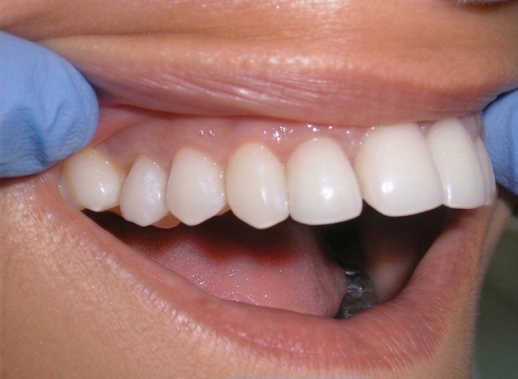 After treatment
