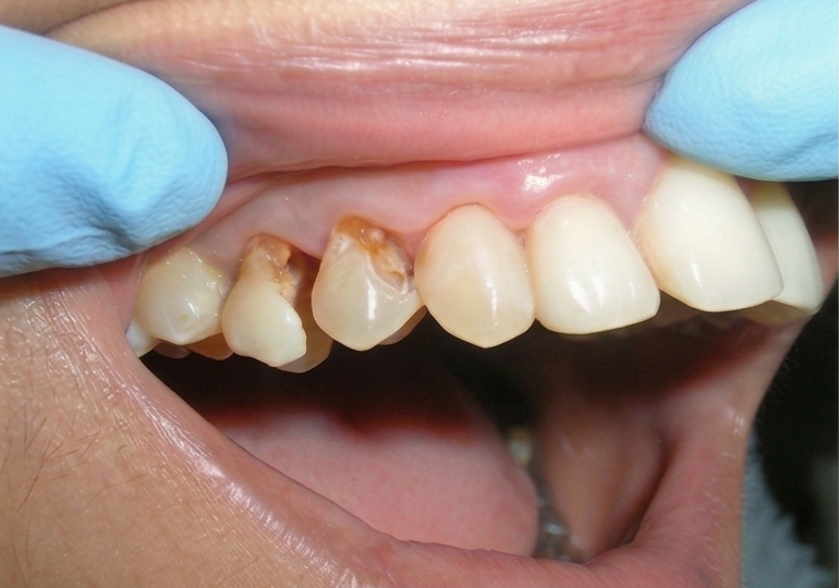 Before treatment