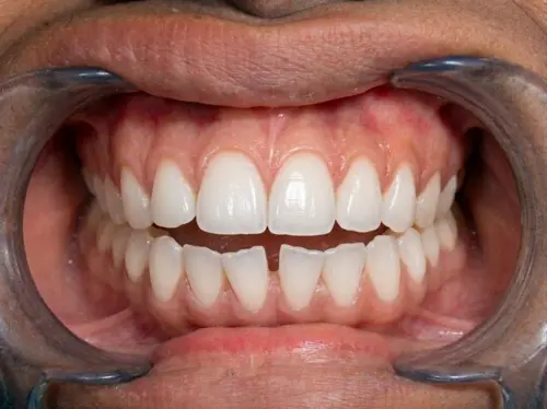 After treatment