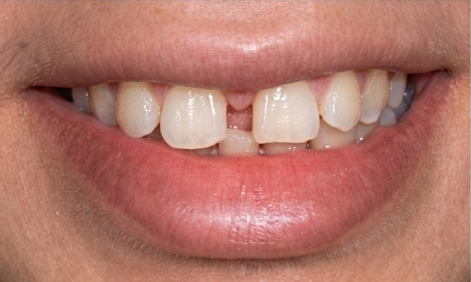 Before treatment