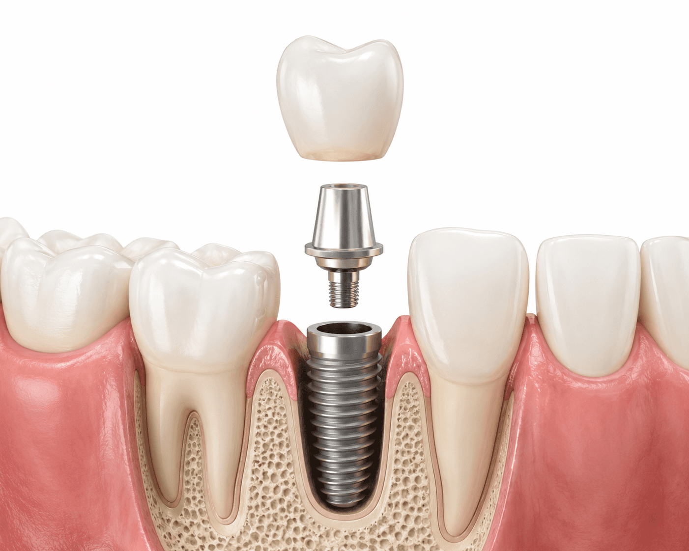 Dental implant — long-term stability