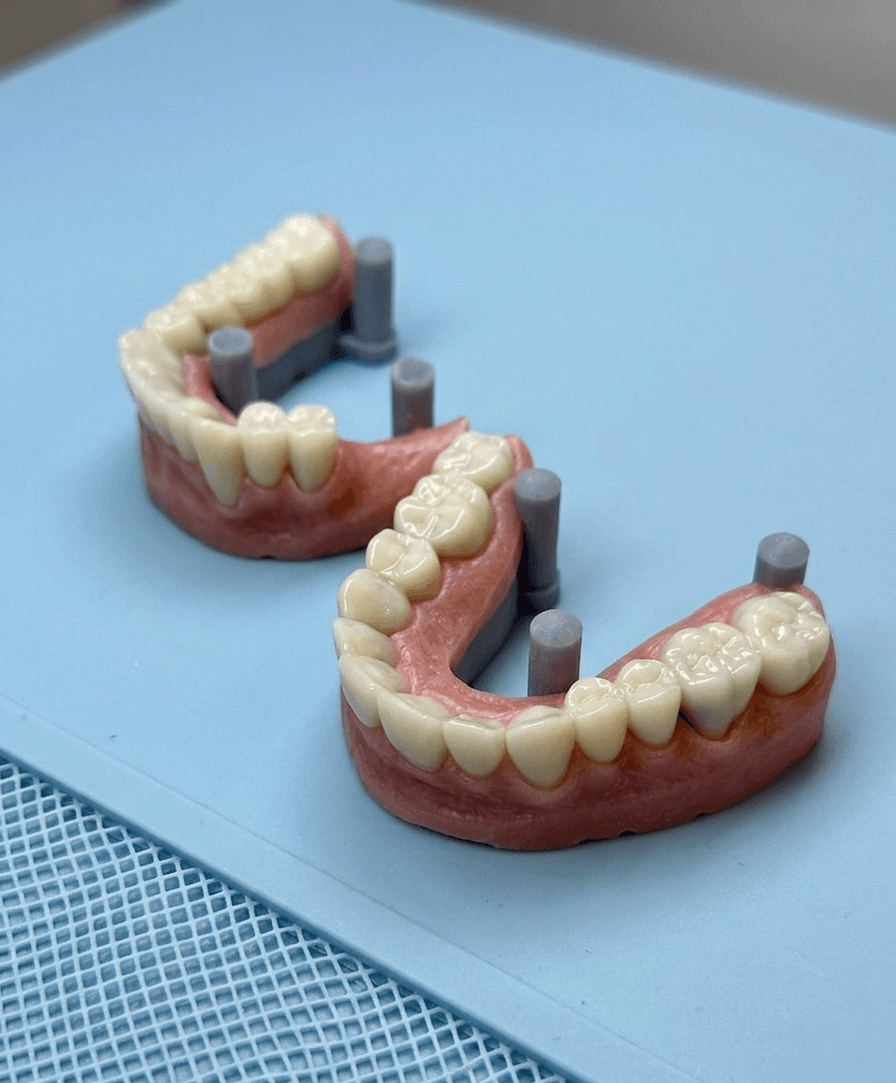 Set of clear aligner progression trays